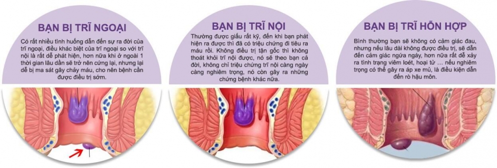 benh tri2